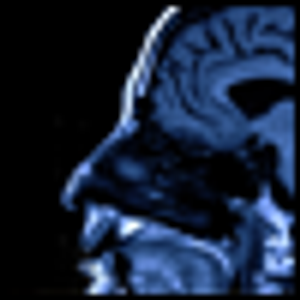 Traumatic Brain Injury Among Veterans Returning From Afghanistan and Iraq