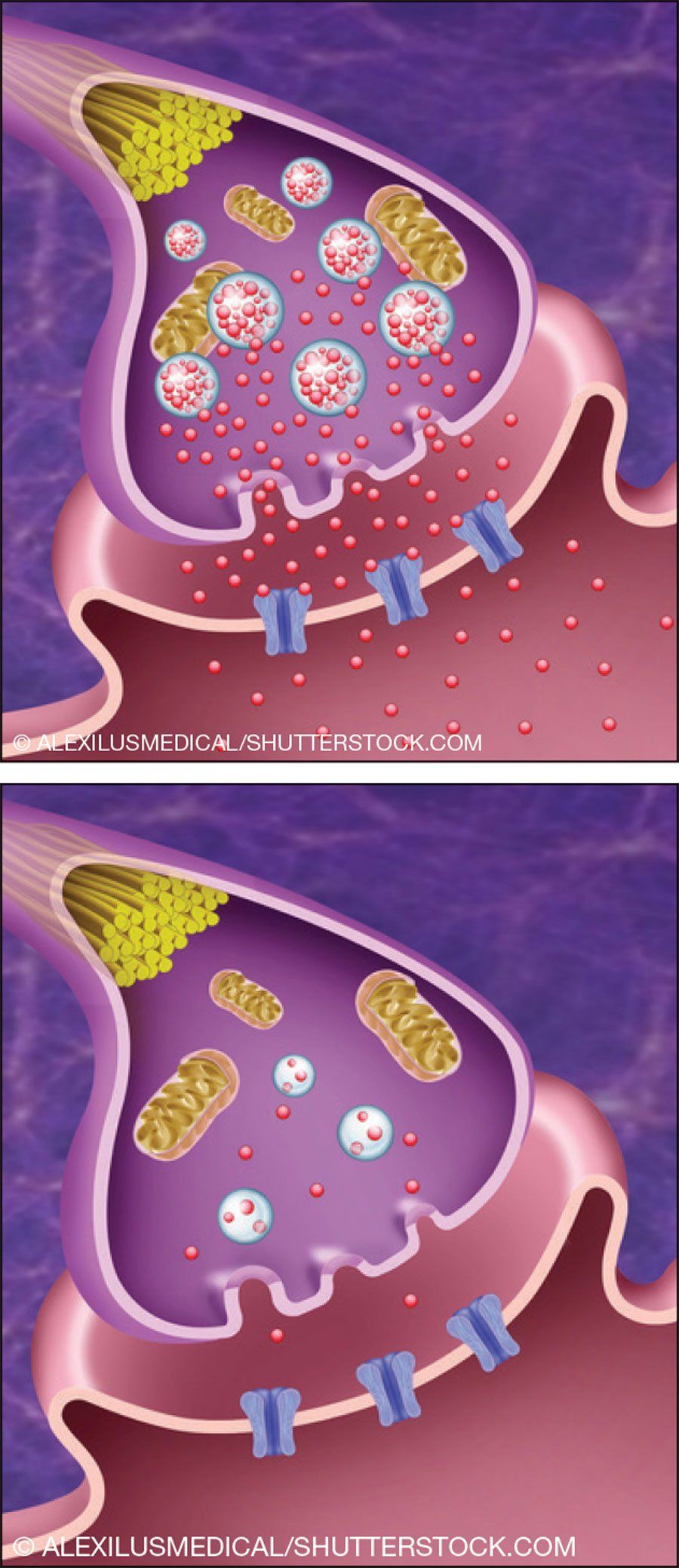 Tardive Dyskinesia: Finally Some Good News