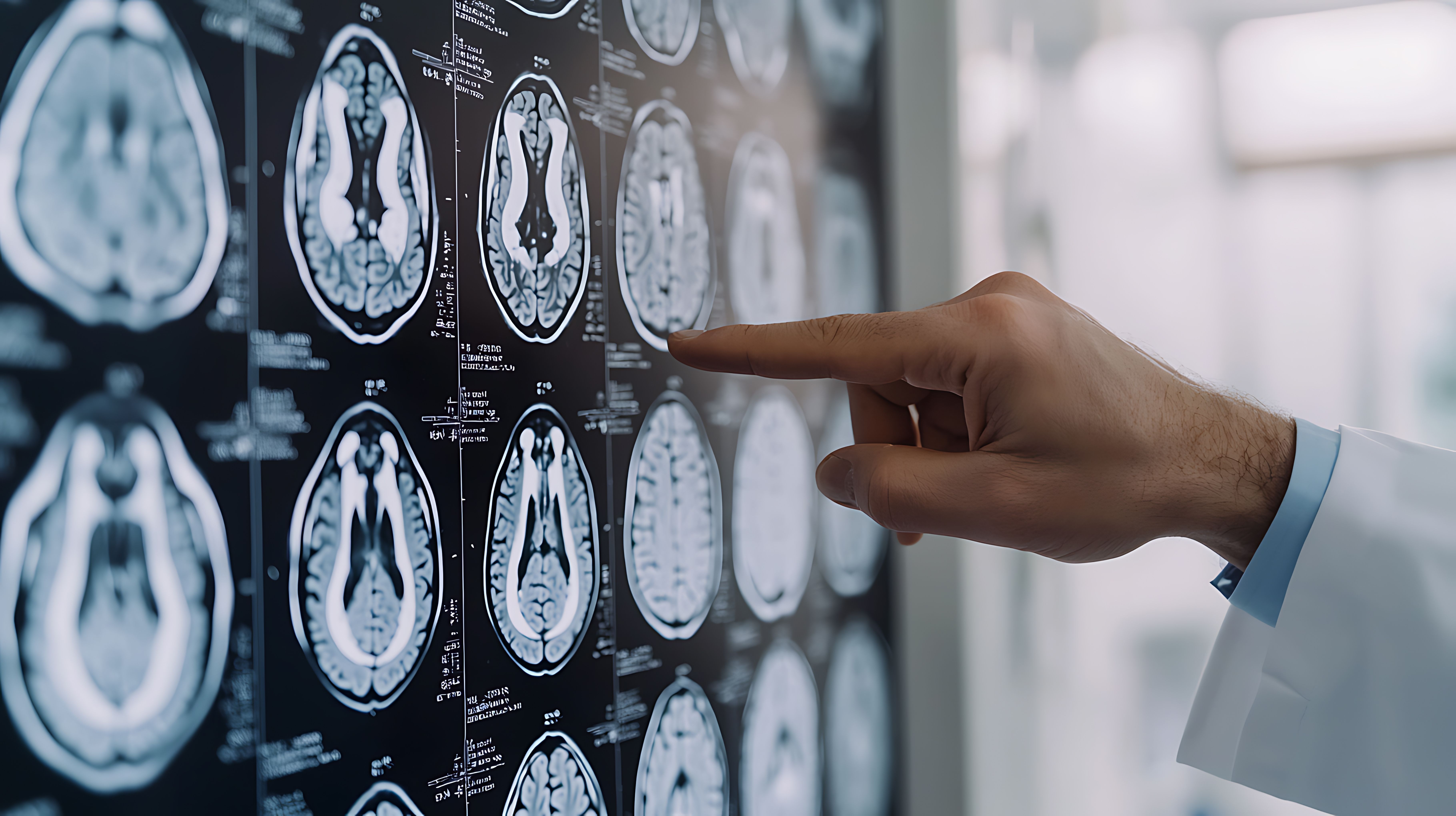frontotemporal dementia granulin mutations PBFT02