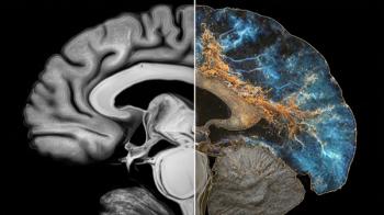 amyloid