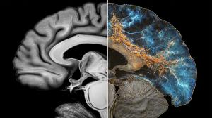 amyloid