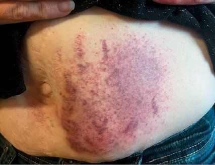 Psychogenic Purpura Psychogenic Purpura