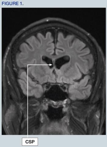 Hippocampal atrophy
