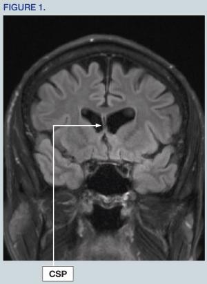 Hippocampal atrophy