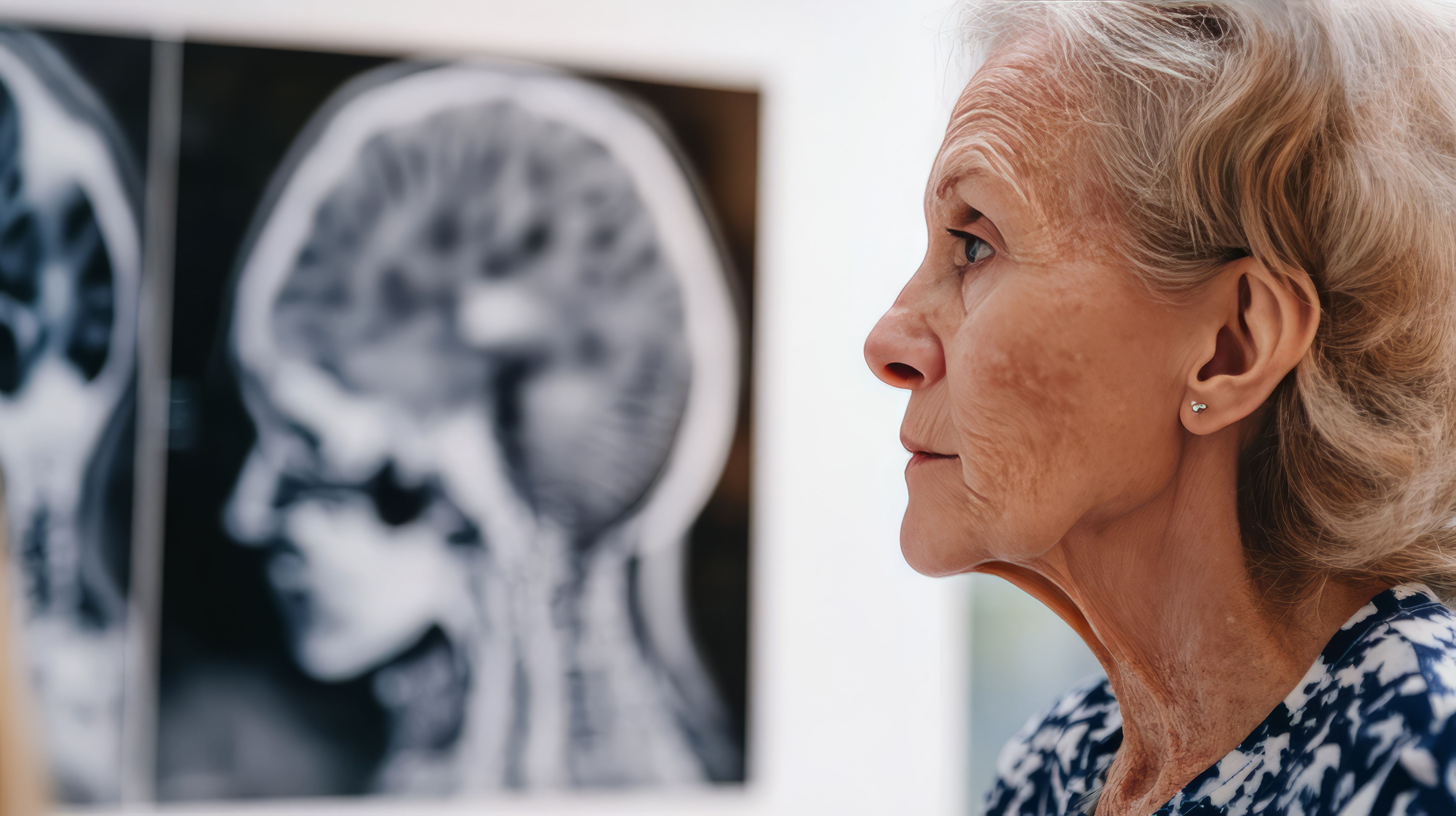Alzheimer