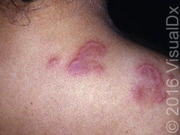 Image IQ:  Smooth plaques with pain and itch