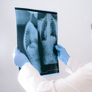 SGLT2 Inhibitors Did Not Increase Fracture Risk in Postmenopausal Patients with T2D