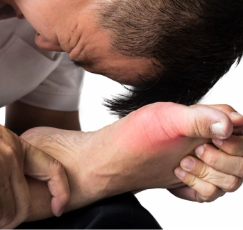 Global Rates of Gout Rising in Young Adults