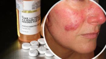 Opioid Use in Systemic Lupus Erythematosus is on the Rise