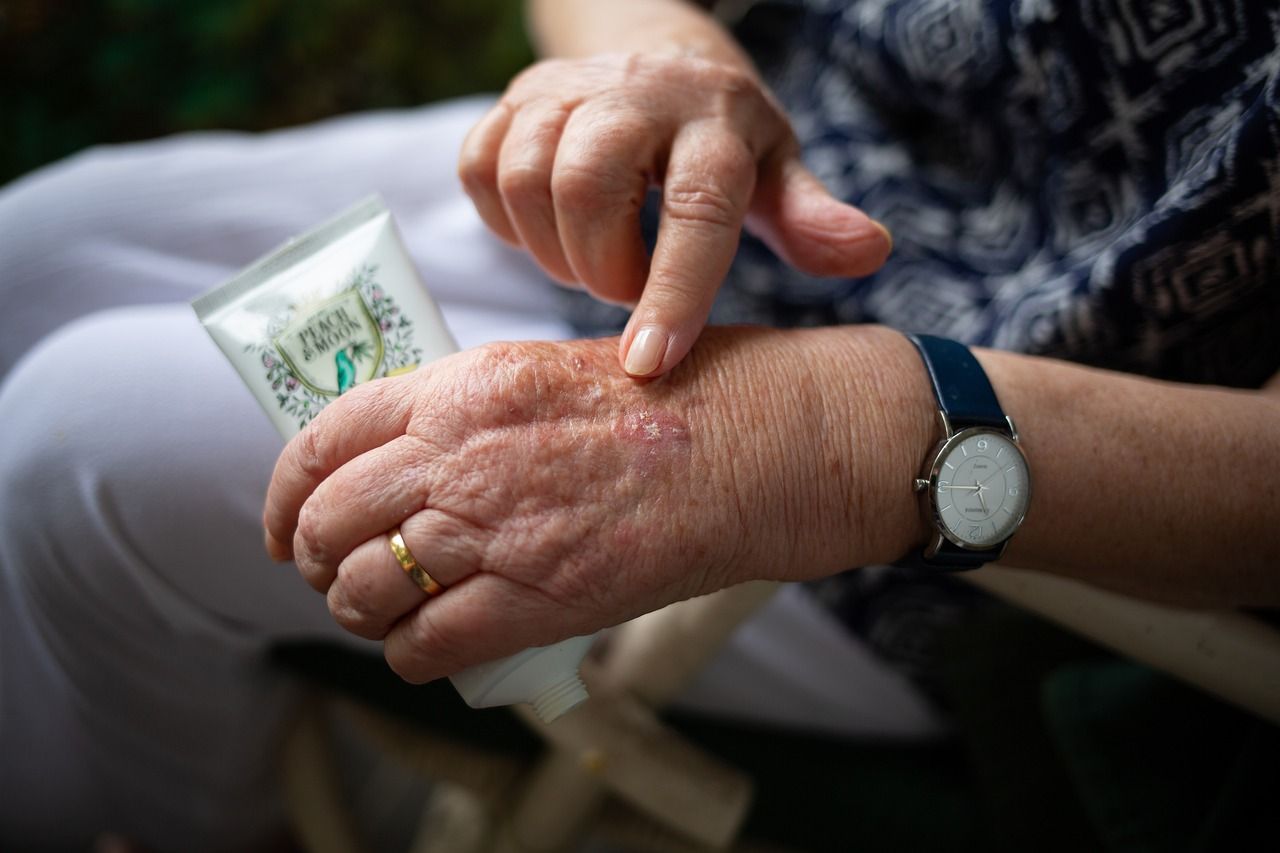 An older person pointing to a patch of dry skin on their arthritic hand | Credit: PeachMoon (Pixabay)