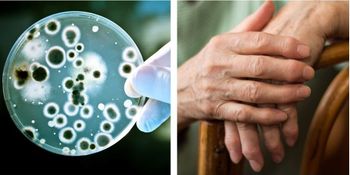 Glucocorticoids and Biologics Share Similar Infection Risk in Rheumatoid Arthritis