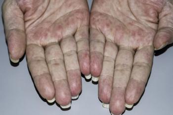 abatacept  Sjögren's syndrome