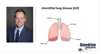 rheumatoid arthritis