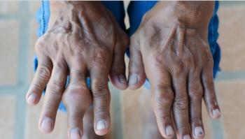 COX-2 Inhibitors Best Traditional NSAIDS for Acute Gout