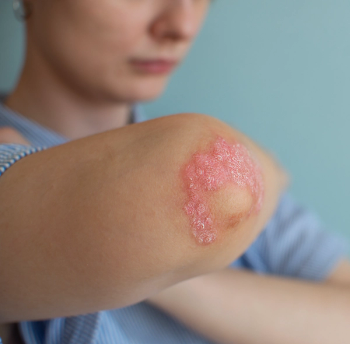 Pivotal Tildrakizumab Trials Meet Endpoint for Psoriatic Arthritis