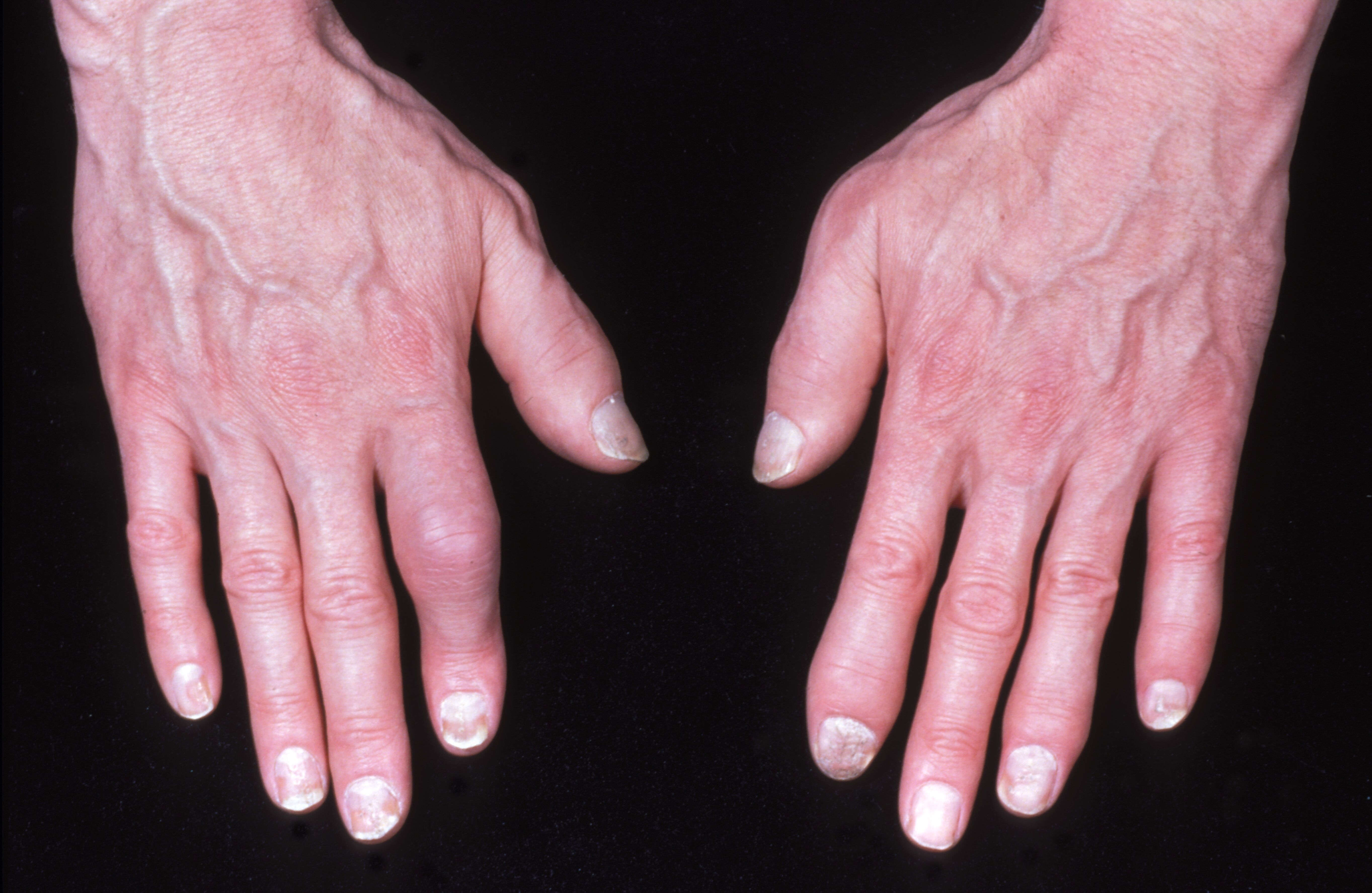 The Burden of Comorbidities Weigh Differently on PsA and AS Patients