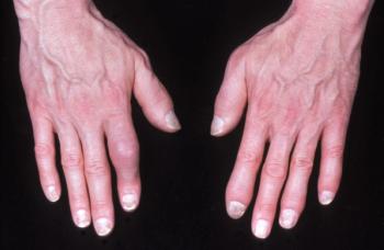 The Burden of Comorbidities Weigh Differently on PsA and AS Patients