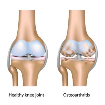Osteoarthritis (©AlilaMedicalMediaShutterstock.com)