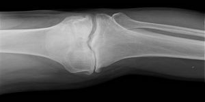 African Americans More Likely to Have Multiple, Large-joint Osteoarthritis