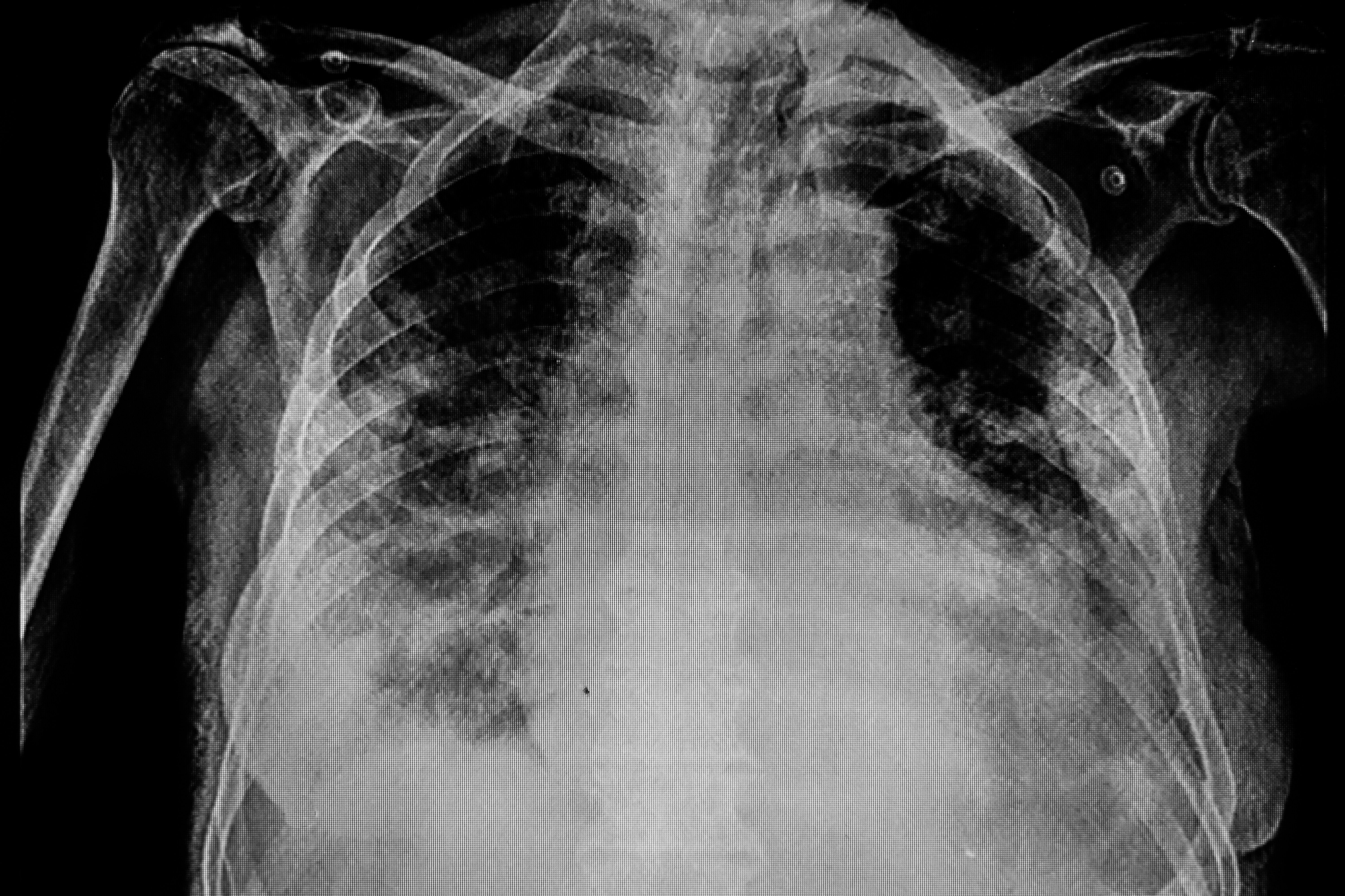pneumonia rheumatoid arthritis