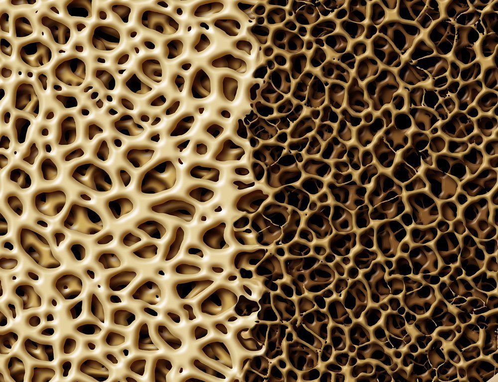 Glucocorticoid Use Results in BMD Loss for Women with Rheumatic Disease