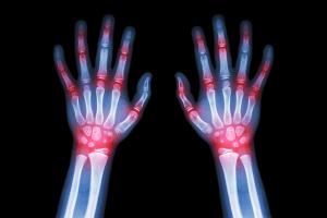 Juvenile arthritis (©AdobeStock_StockDevil)