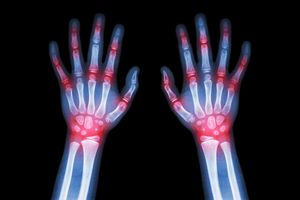 Juvenile arthritis (©AdobeStock_StockDevil)