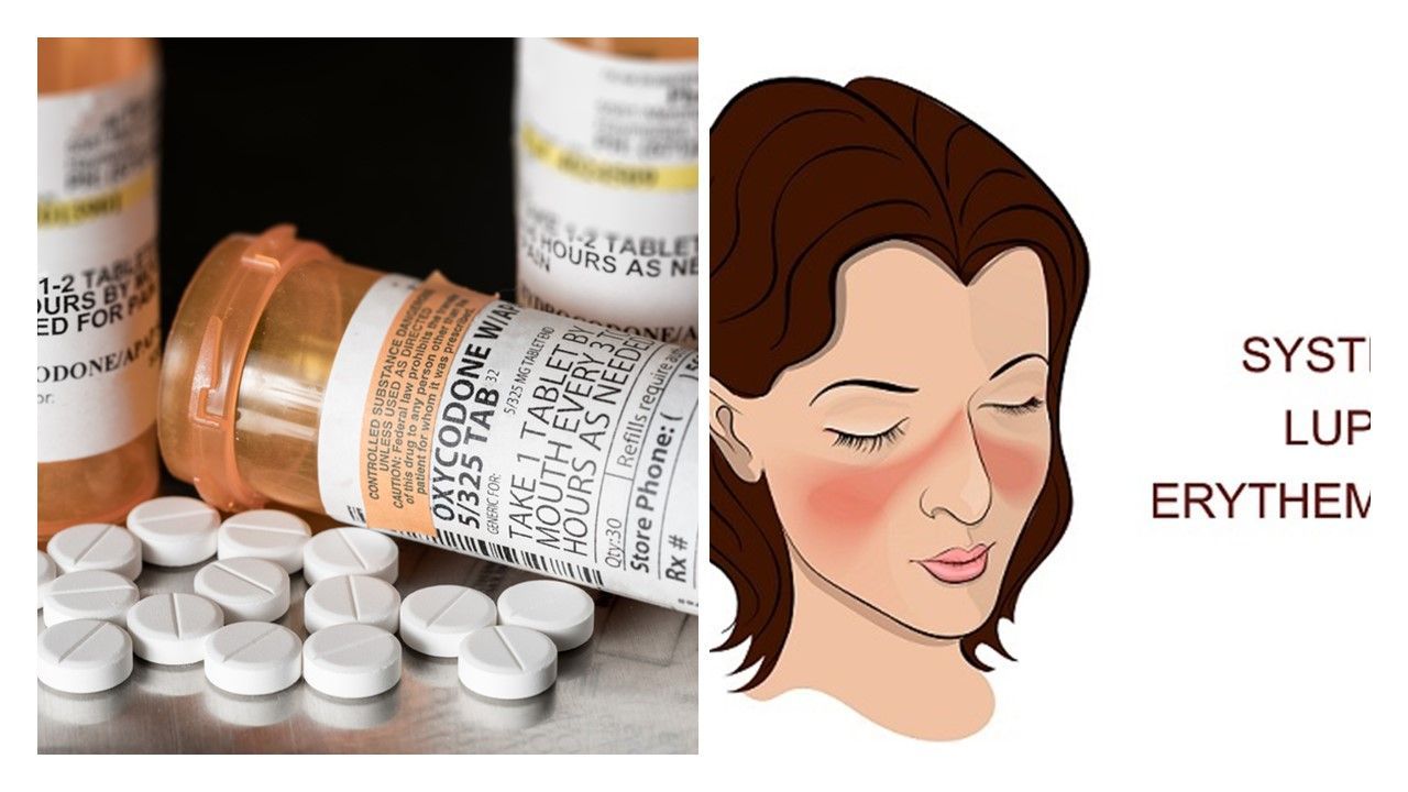 High Rates of Inappropriate Opioid Use Found in SLE