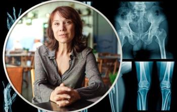 Individualized Approach Needed for Bisphosphonate Use in Women