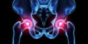 Platelet-Rich Plasma Treatment More Effective than Cortisone for Chronic Hip Bursitis