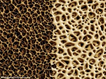 osteoporosis, bone mineral density, genetics, fracture risk, patients