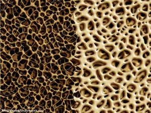 osteoporosis, bone mineral density, genetics, fracture risk, patients