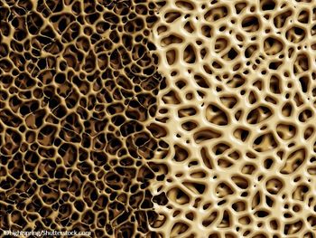 osteoporosis, bone mineral density, genetics, fracture risk, patients
