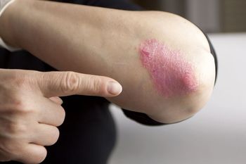 Psoriasis