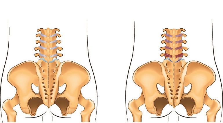 DNA methylation inflammatory bowel disease, psoriasis, AS