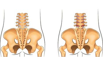 Ankylosing Spondylitis (©AdobeStock_Artemidapsy) - Copy