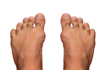 Gout, a common comorbidity in renal transplant patients.