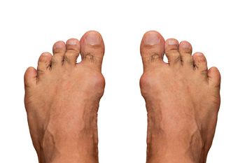 Gout, a common comorbidity in renal transplant patients.