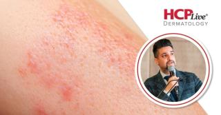 Bridging the Treatment Gap in Pediatric Psoriasis and PsA With Guselkumab, With Vimal H. Prajapati, MD