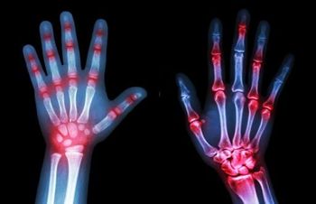 Tips for Transitioning a Juvenile Idiopathic Arthritis Patient to Adult Care