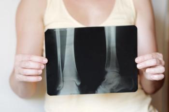 High-Dose Statins Increase Osteoporosis Risk