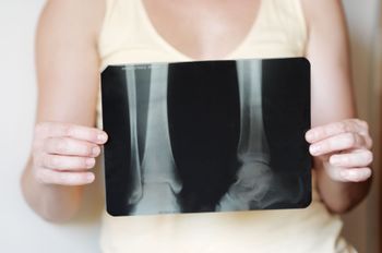 High-Dose Statins Increase Osteoporosis Risk