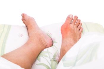 Gout man feet toes bed obese obesity