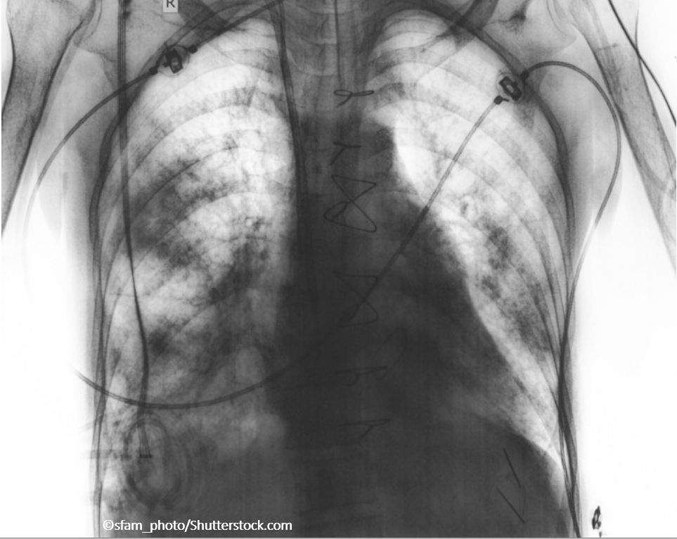 COPD May Be Causally Linked to Rheumatoid Arthritis, Osteoarthritis