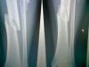 Speedy Recovery Expected for Louisville Basketball Player's Open Tibia Fracture 