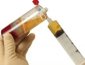 Platelet-Rich Plasma Treatment Delays Cartilage Degeneration in Knee Osteoarthritis Patients