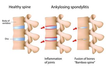 Are radiographic axSpA and ankylosing spondylitis one in the same?
