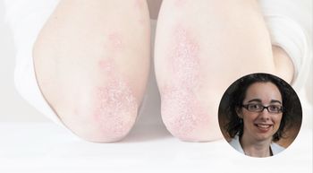 psoriatic arthritis patient outcomes