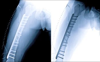 Atypical Bone Fracture Risk Rises With Bisphosphonates