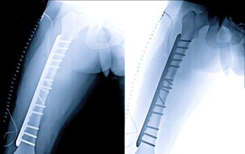 Atypical Bone Fracture Risk Rises With Bisphosphonates